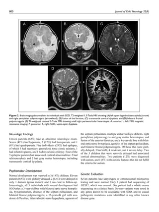 Neurologic Findings
Eleven patients (65%) had an abnormal neurologic exam.
Seven (41%) had hypotonia, 2 (12%) had hemiparesis, and 1
(6%) had quadriparesis. Five individuals (29%) had epilepsy,
of which 3 had secondary generalized tonic clonic seizures, 1
had infantile spasms, and 1 had myoclonic epilepsy. Four of the
5 epileptic patients had associated cortical abnormalities: 2 had
schizencephaly and 2 had gray matter heterotopia, including
transmantle cortical dysplasia.
Psychomotor Development
Normal development was reported in 3 (18%) children. Eleven
patients (65%) were globally delayed, 2 (12%) were delayed in
only 1 domain (gross motor), and 1 was lost to follow-up.
Interestingly, all 3 individuals with normal development had
SOD-plus: a 3-year-old boy with bilateral optic nerve hypopla-
sia, hypopituitarism, absence of the septum pellucidum, and
bilateral frontal polymicrogyria; a 17-year-old girl with aca-
demic difficulties, bilateral optic nerve hypoplasia, agenesis of
the septum pellucidum, multiple endocrinologic deficits, right
perisylvian polymicrogyria and gray matter heterotopias, and
fusion of the anterior fornices; and a 6-year-old boy with bilat-
eral optic nerve hypoplasia, agenesis of the septum pellucidum,
and bilateral frontal polymicrogyria. Of those that were glob-
ally delayed, 3 had mild, 4 moderate, and 4 severe delay. Two
of the 3 children that were severely delayed had associated
cortical abnormalities. Two patients (12%) were diagnosed
with autism, and 1 (6%) with autistic features that did not fulfill
the criteria for autism.
Genetic Evaluation
Seven patients had karyotypes or chromosomal microarray
testing and were normal. Only 1 patient had sequencing of
HESX1, which was normal. One patient had a whole exome
sequencing on a clinical basis. No rare variants were noted in
any genes known to be associated with SOD, and no causal
pathogenic mutations were identified in any other known
disease gene.
Figure 2. Brain imaging abnormalities in individuals with SOD. T2-weighted 1.5-Tesla MRI showing (A) left open-lipped schizencephaly (arrow)
and right perisylvian polymicrogyria (arrowhead), (B) fusion of the fornices, (C) transmantle cortical dysplasia, and (D) bilateral frontal
polymicrogyria. (E) T1-weighted coronal 3-Tesla MRI showing small right periventricular heterotopia. A, anterior, L, left; MRI, magnetic
resonance imaging; P, posterior; R, right; SOD, septo-optic dysplasia.
800 Journal of Child Neurology 32(9)
 
