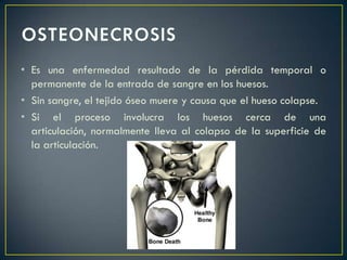 • Es una enfermedad resultado de la pérdida temporal o
  permanente de la entrada de sangre en los huesos.
• Sin sangre, el tejido óseo muere y causa que el hueso colapse.
• Si el proceso involucra los huesos cerca de una
  articulación, normalmente lleva al colapso de la superficie de
  la articulación.
 