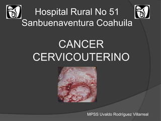 Hospital Rural No 51 Sanbuenaventura Coahuila CANCER CERVICOUTERINO MPSS Uvaldo Rodríguez Villarreal 