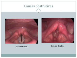 Causas obstrutivas
Glote normal Edema de glote
 