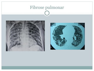 Fibrose pulmonar
 