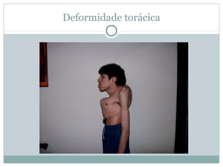 Deformidade torácica
 