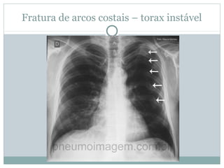 Fratura de arcos costais – torax instável
 