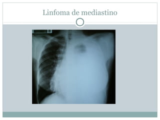Linfoma de mediastino
 