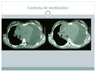 Linfoma de mediastino
 
