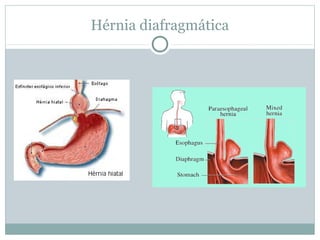 Hérnia diafragmática
 