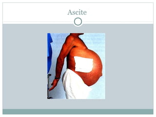 Ascite
 