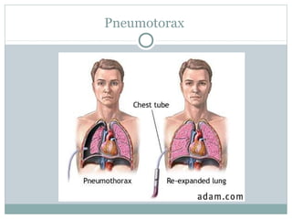 Pneumotorax
 
