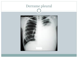 Derrame pleural
 