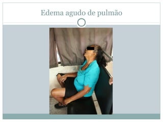 Edema agudo de pulmão
 