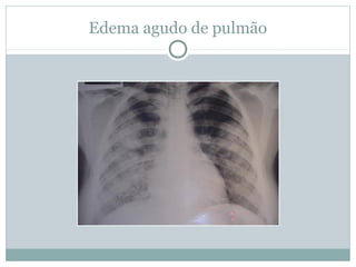 Edema agudo de pulmão
 