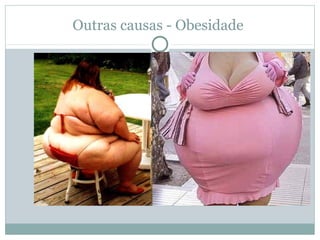 Outras causas - Obesidade
 