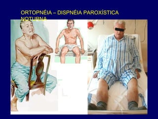 ORTOPNÉIA – DISPNÉIA PAROXÍSTICA
NOTURNA
 