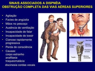 SINAIS ASSOCIADOS A DISPNÉIASINAIS ASSOCIADOS A DISPNÉIA
OBSTRUÇÃO COMPLETA DAS VIAS AÉREAS SUPERIORESOBSTRUÇÃO COMPLETA DAS VIAS AÉREAS SUPERIORES
• AgitaçãoAgitação
• Facies de angústiaFacies de angústia
• Mãos no pescoçoMãos no pescoço
• Ausência de ventilaçãoAusência de ventilação
• Incapacidade de falarIncapacidade de falar
• Incapacidade de tossirIncapacidade de tossir
• Cianose rapidamenteCianose rapidamente
progressivaprogressiva
• Perda de consciênciaPerda de consciência
• Causas:Causas:
corpo estranhocorpo estranho
anafilaxiaanafilaxia
traqueomaláciatraqueomalácia
discinesia cordas vocaisdiscinesia cordas vocais
 