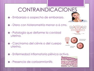 CONTRAINDICACIONES
 - Embarazo o sospecha de embarazo.
 - Útero con histerometría menor a 6 cms.
 - Patología que deforme la cavidad
uterina.
 - Carcinoma del cérvix o del cuerpo
uterino.
 - Enfermedad inflamatoria pélvica activa.
 - Presencia de corioamnionitis
 