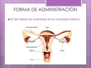 FORMA DE ADMINISTRACIÓN
 El DIU debe ser insertado en la cavidad uterina.
 