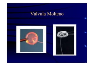 Valvula Molteno
 