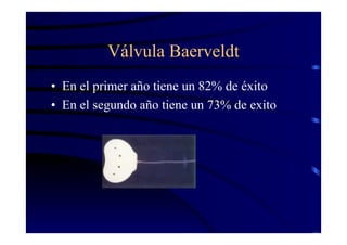 Válvula Baerveldt
• En el primer año tiene un 82% de éxito
• En el segundo año tiene un 73% de exito
 