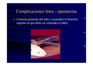 Complicaciones Intra - operatorias
• Correcta posición del tubo ( recuerden la bisectriz
angular en que debe ser colocado el tubo)
 