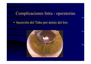 Complicaciones Intra - operatorias
• Inserción del Tubo por detrás del Iris:
 