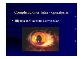 Complicaciones Intra - operatorias
• Hipema en Glaucoma Neovascular
 