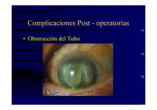 Complicaciones Post - operatorias
• Obstrucción del Tubo
 
