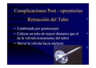 Retracción del Tubo
• Confirmada por gonioscopia
• Colocar un tubo de mayor diametro que el
de la valvula (extensiones del tubo)
• Mover la válvula hacia adelante
Complicaciones Post - operatorias
 