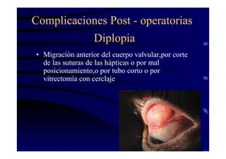Diplopia
• Migración anterior del cuerpo valvular,por corte
de las suturas de las hápticas o por mal
posicionamiento,o por tubo corto o por
vitrectomía con cerclaje
Complicaciones Post - operatorias
 