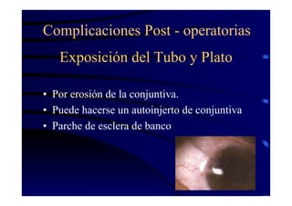 Exposición del Tubo y Plato
• Por erosión de la conjuntiva.
• Puede hacerse un autoinjerto de conjuntiva
• Parche de esclera de banco
Complicaciones Post - operatorias
 