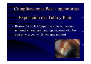 Exposición del Tubo y Plato
• Resorción de la Conjuntiva (puede hacerse
un tunel en esclera para reposicionar el tubo
con un crescent) (técnica que utilizo)
Complicaciones Post - operatorias
 