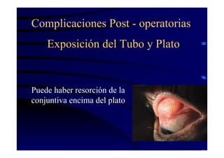 Exposición del Tubo y Plato
Puede haber resorción de la
conjuntiva encima del plato
Complicaciones Post - operatorias
 
