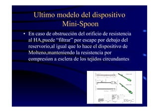 Ultimo modelo del dispositivo
Mini-Spoon
• En caso de obstrucción del orificio de resistencia
al HA,puede “filtrar” por escape por debajo del
reservorio,al igual que lo hace el dispositivo de
Molteno,manteniendo la resistencia por
compresion a esclera de los tejidos circundantes
 