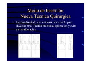 Modo de Inserción
Nueva Técnica Quirurgica
• Hemos diseñado una unidosis descartable para
inyectar 5FU ,facilita mucho su aplicación y evita
su manipulación
 