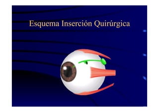 Esquema Inserción Quirúrgica
 