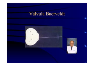 Valvula Baerveldt
 