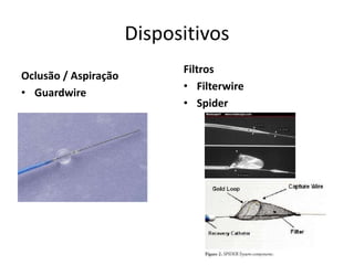 Dispositivos 
Oclusão / Aspiração 
• Guardwire 
Filtros 
• Filterwire 
• Spider 
 