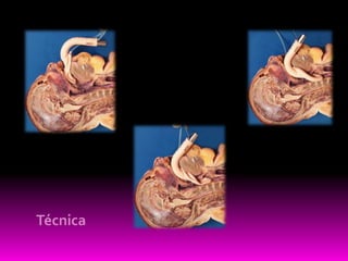 Obstrucción  glótica 