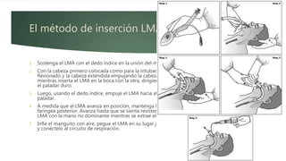 El método de inserción LMA "estándar".
1. Sostenga el LMA con el dedo índice en la unión del manguito y el tubo.
2. Con la cabeza primero colocada como para la intubación normal, mantenga el cuello
flexionado y la cabeza extendida empujando la cabeza desde atrás con una mano
mientras inserta el LMA en la boca con la otra, dirigiendo inicialmente la punta contra
el paladar duro.
3. Luego, usando el dedo índice, empuje el LMA hacia atrás y hacia abajo contra el
paladar.
4. A medida que el LMA avanza en posición, mantenga la presión contra la pared
faríngea posterior. Avanza hasta que se sienta resistencia. Presione hacia abajo el tubo
LMA con la mano no dominante mientras se extrae el dedo.
5. Infle el manguito con aire, pegue el LMA en su lugar junto con un bloque de mordida
y conéctelo al circuito de respiración.
 