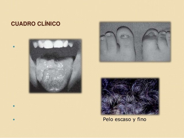 Las desapariciones del hongo de la pared los medios públicos