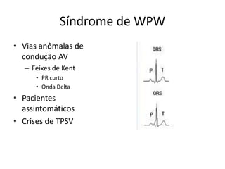 Síndrome de WPW
• Vias anômalas de
  condução AV
  – Feixes de Kent
     • PR curto
     • Onda Delta
• Pacientes
  assintomáticos
• Crises de TPSV
 