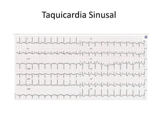 Taquicardia Sinusal
 