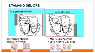 3.TAMAÑO DEL QRS
A. Supraventricular
• Morfología Normal
• Duración Normal
A. Ventricular
• Morfología Anormal
• QRS Ancho ( 0,12 seg)
 