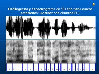 Oscilograma y espectrograma de "El año tiene cuatro estaciones" (locutor con disartria FL)                                                                                   