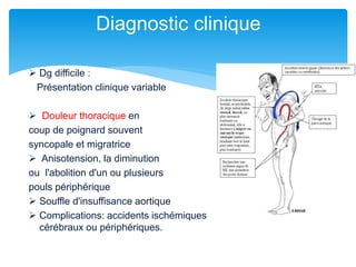  Dg difficile :
Présentation clinique variable
 Douleur thoracique en
coup de poignard souvent
syncopale et migratrice
 Anisotension, la diminution
ou l'abolition d'un ou plusieurs
pouls périphérique
 Souffle d'insuffisance aortique
 Complications: accidents ischémiques
cérébraux ou périphériques.
Diagnostic clinique
 