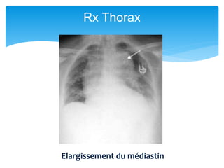 Rx Thorax
Elargissement du médiastin
 