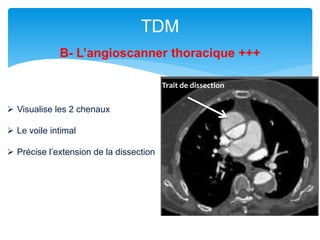TDM
B- L’angioscanner thoracique +++
Trait de dissection
 Visualise les 2 chenaux
 Le voile intimal
 Précise l’extension de la dissection
 