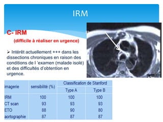 IRM
Flap intimalC- IRM
(difficile à réaliser en urgence)
 Intérêt actuellement +++ dans les
dissections chroniques en raison des
conditions de l ’examen (malade isolé)
et des difficultés d’obtention en
urgence.
 