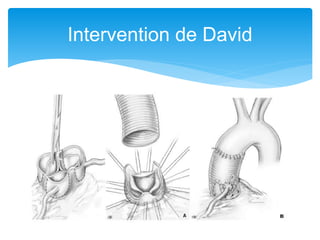 Intervention de David
 