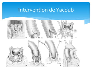 Intervention de Yacoub
 