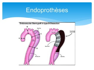 Endoprothèses
 